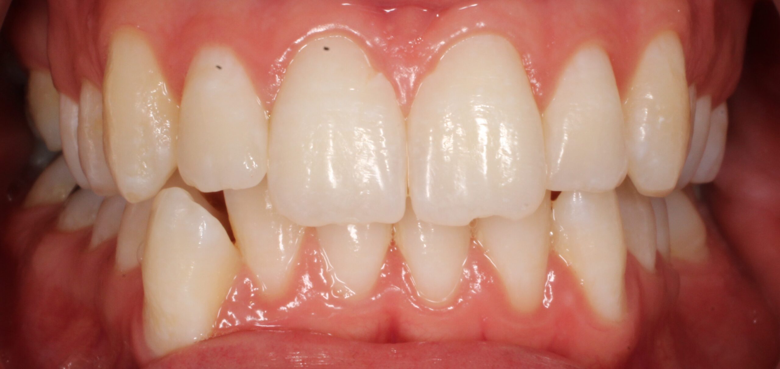 Before braces front teeth