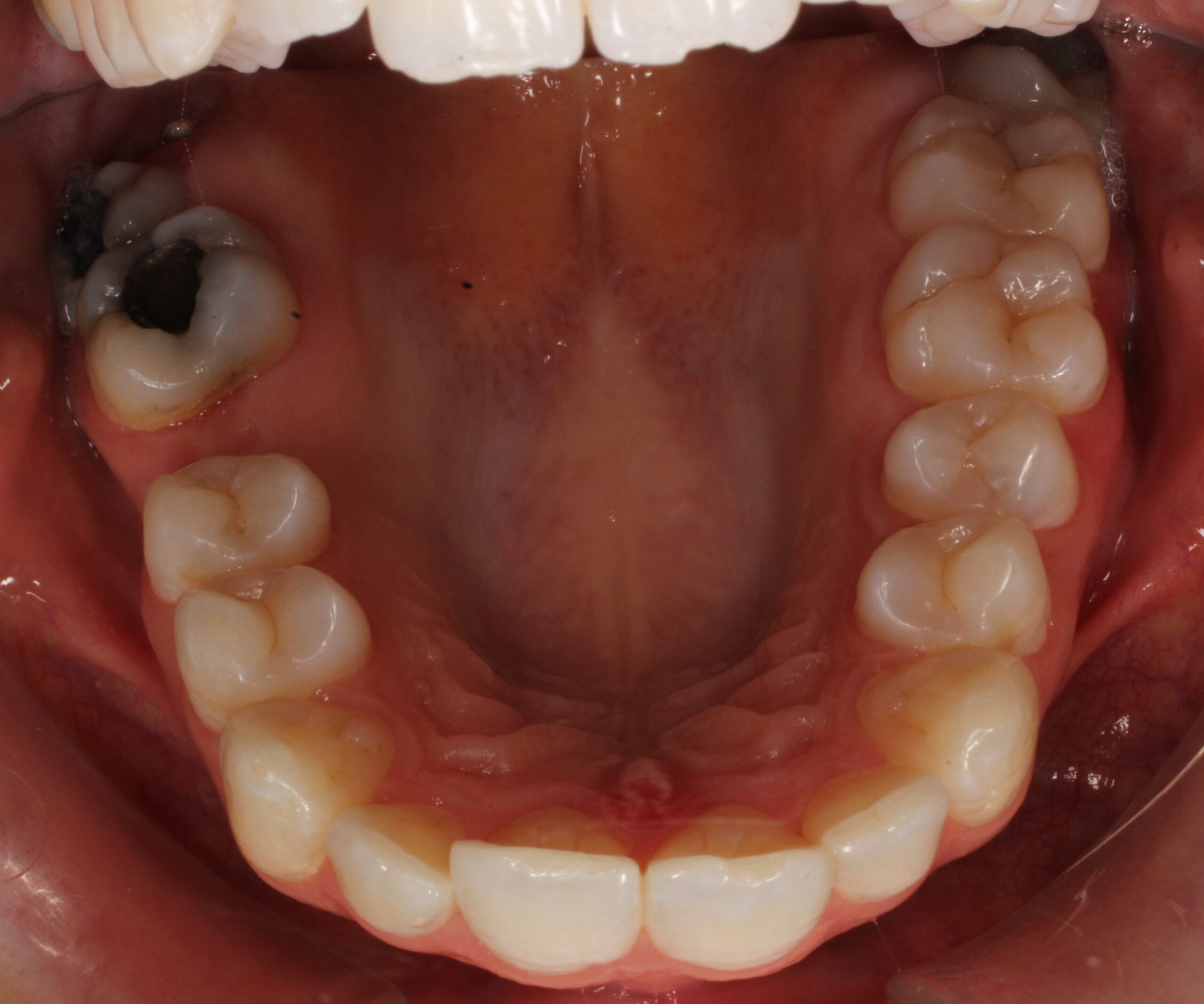 Before braces upper teeth
