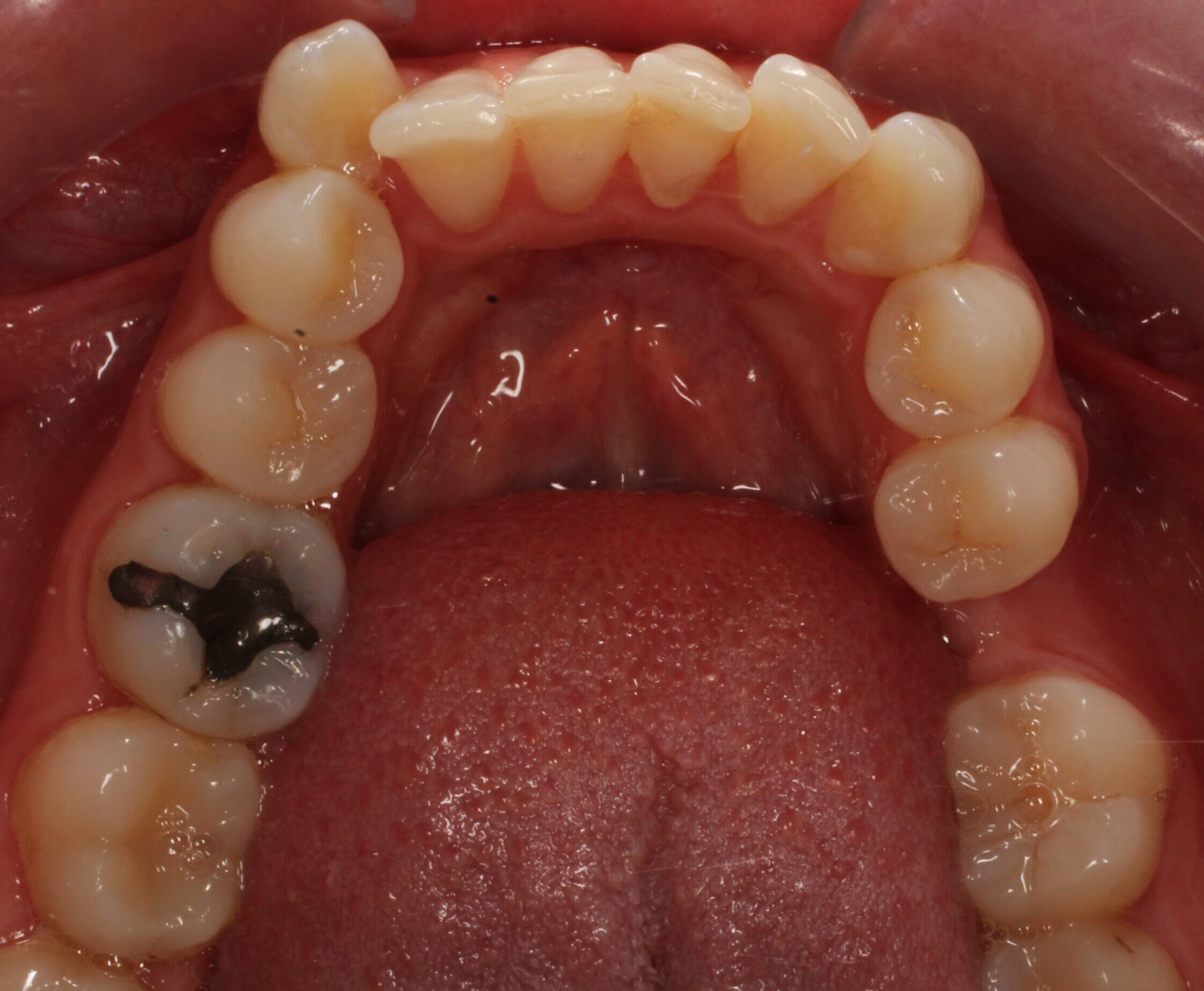 Before braces lower teeth