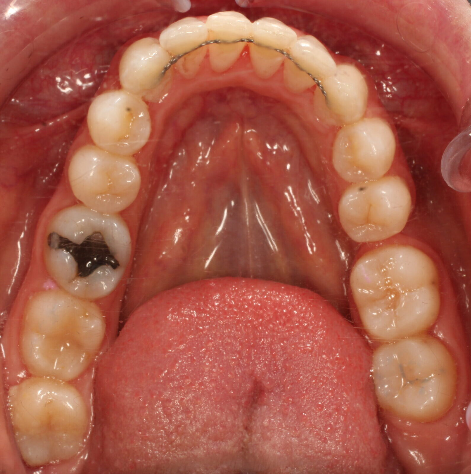 After braces lower teeth