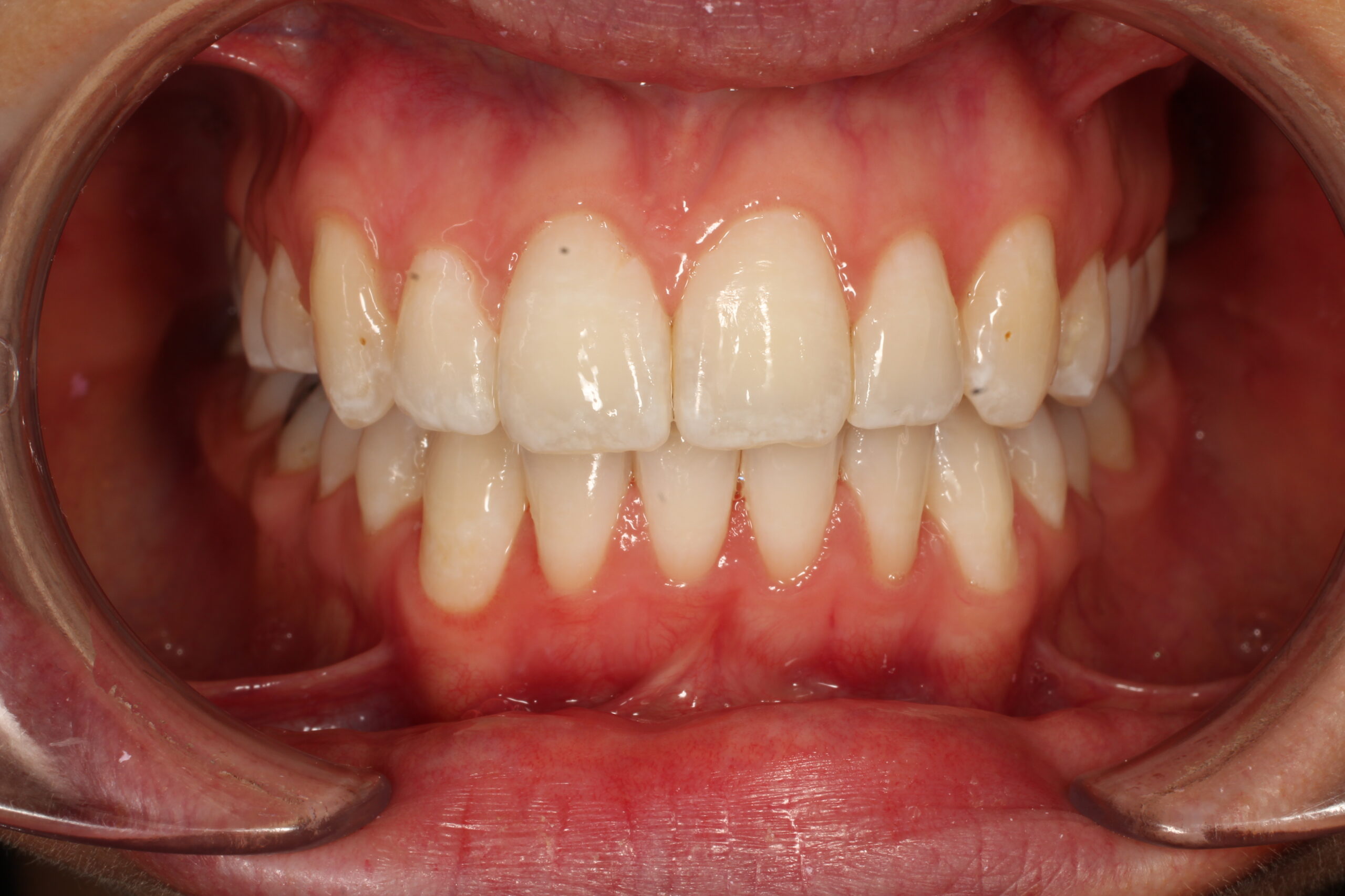 After braces front teeth