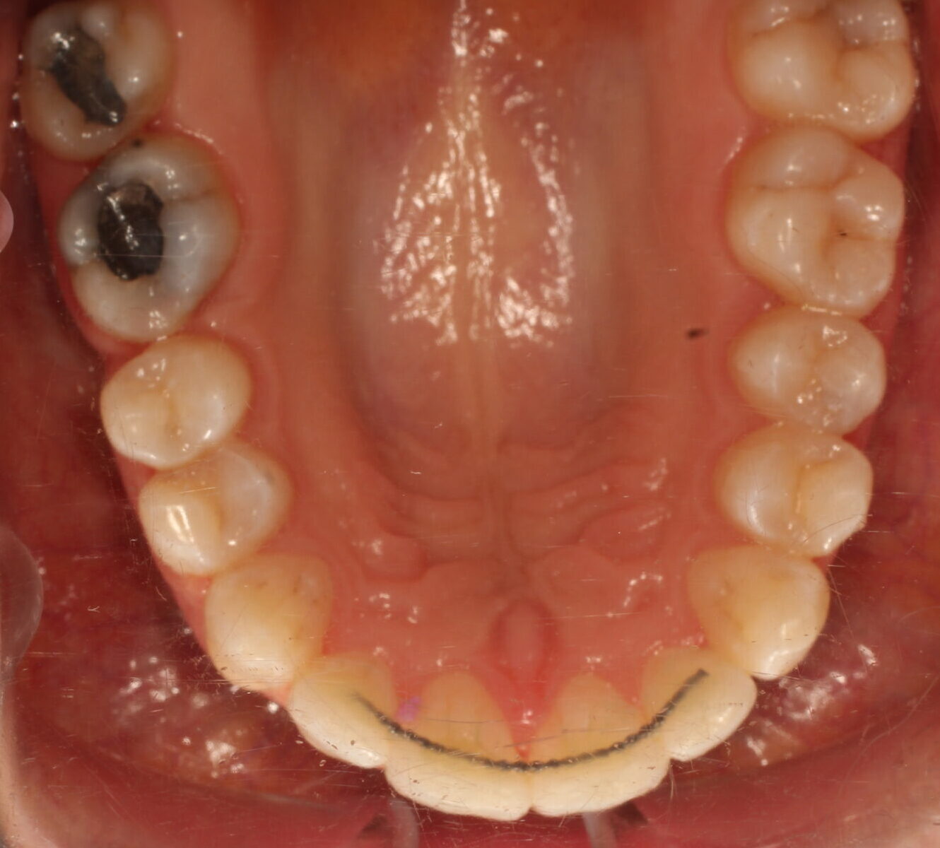 After braces upper teeth