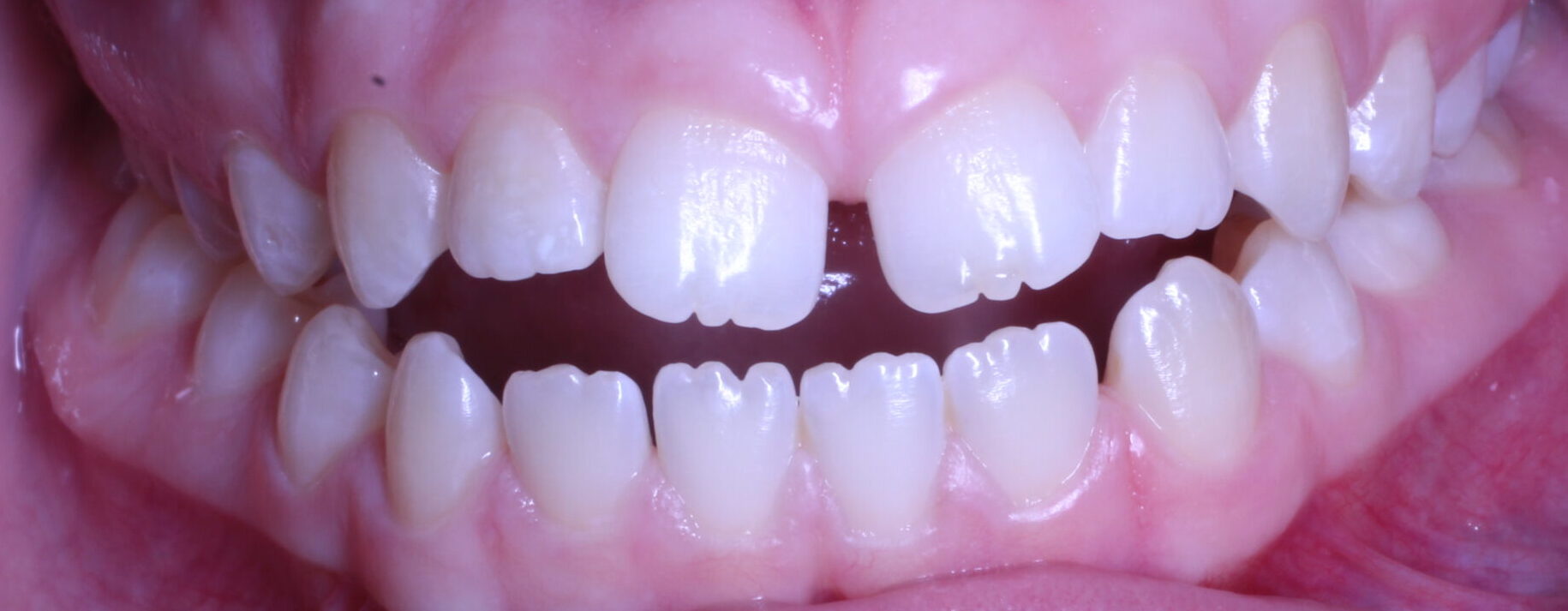 Before braces front teeth