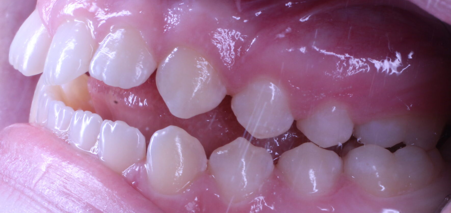 Before braces left teeth