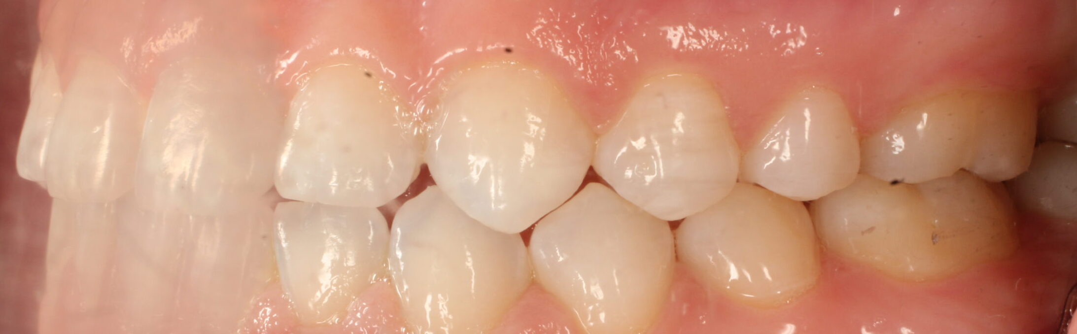 After braces left teeth