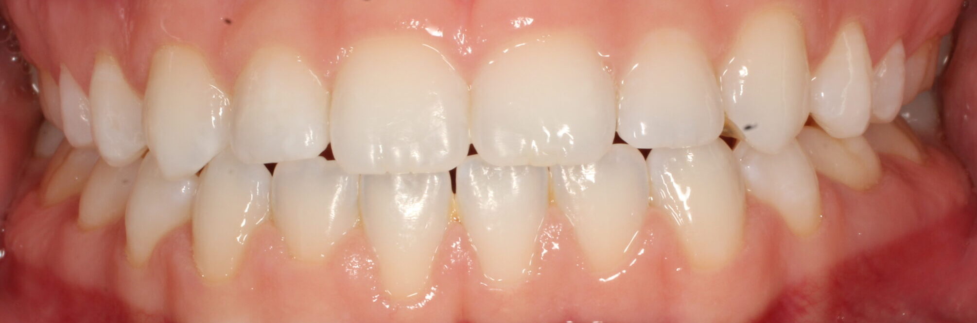 After braces front teeth