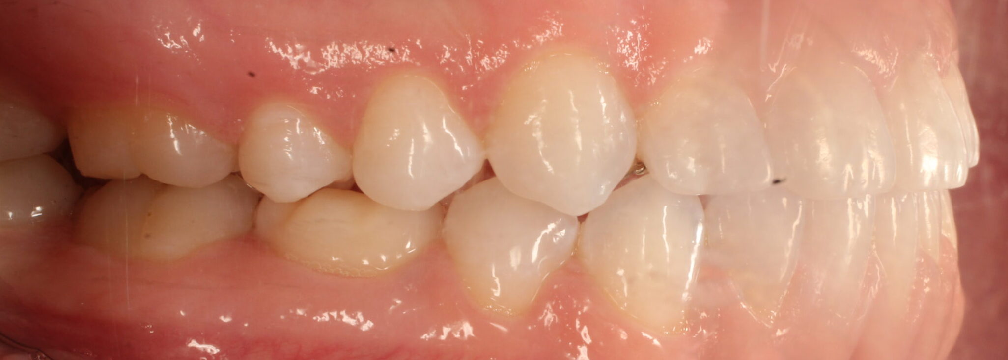 After braces right teeth