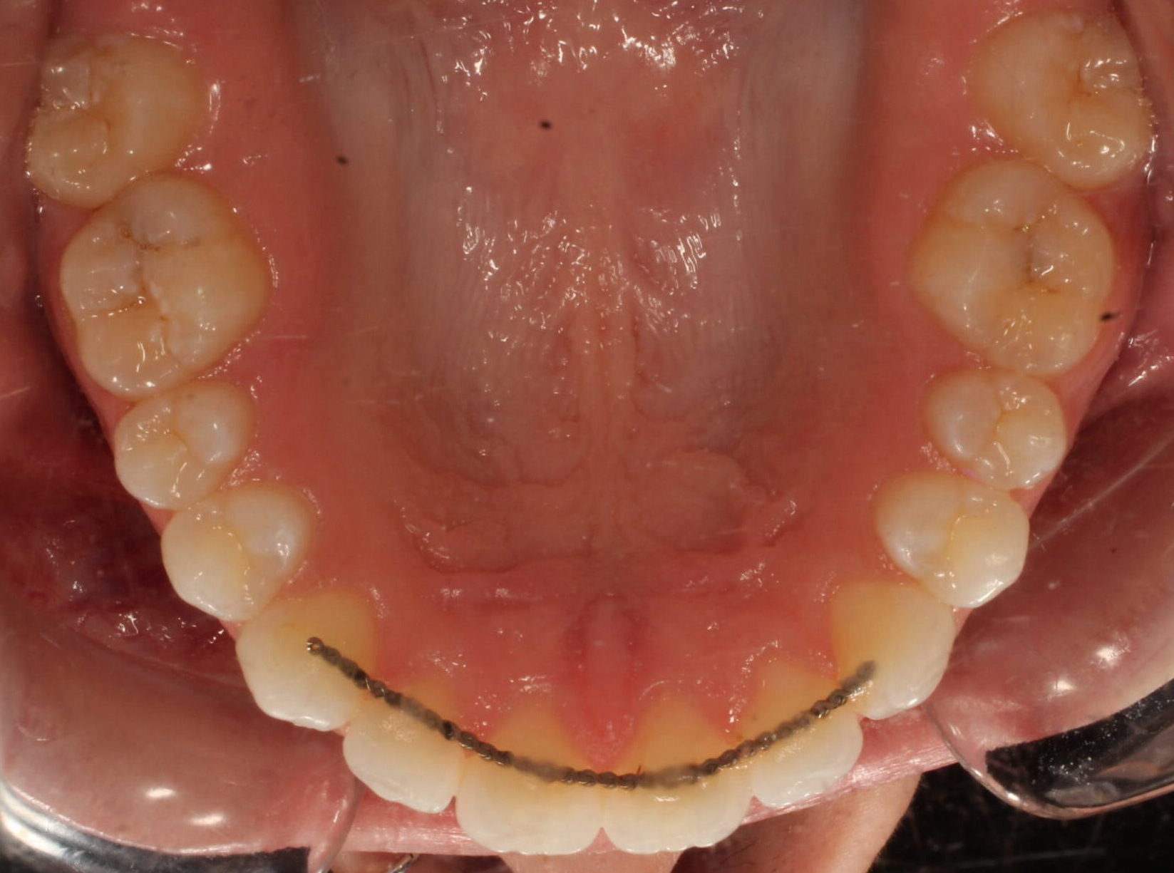 After braces upper teeth