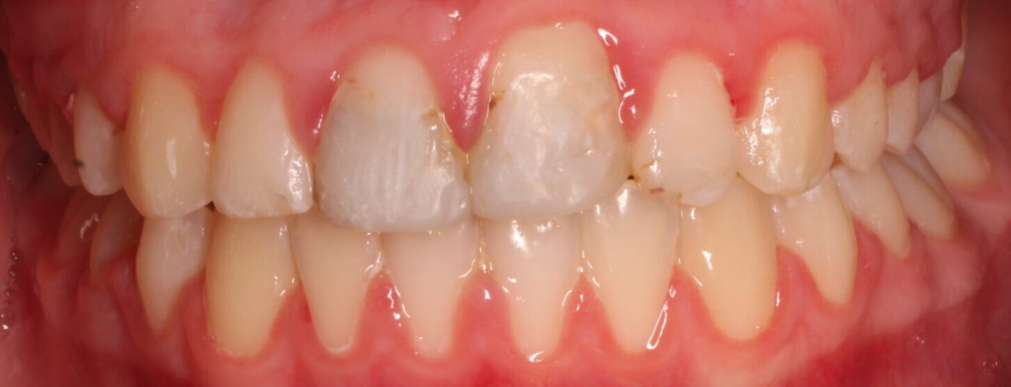 After braces front teeth