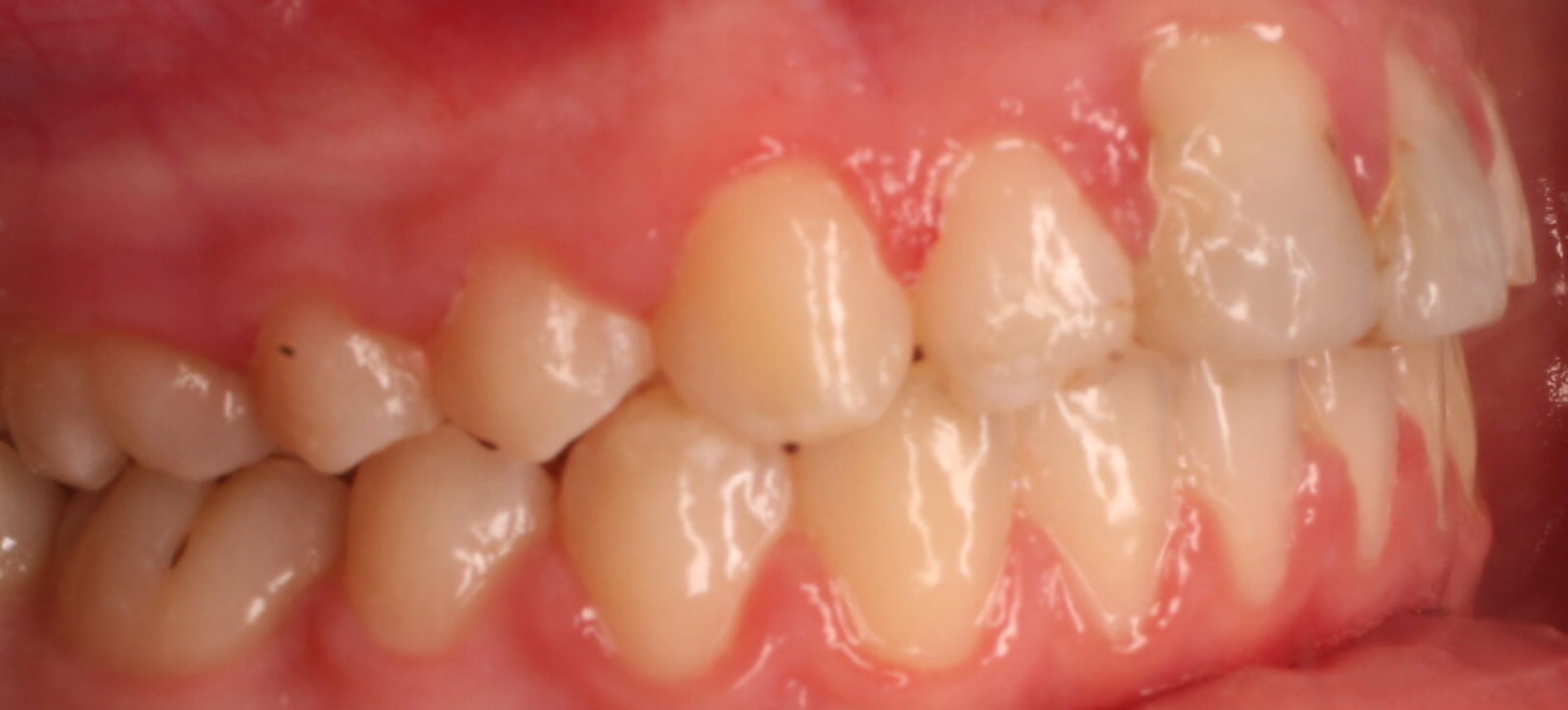 After braces right teeth