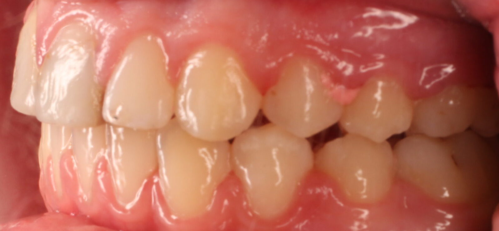 After braces left teeth