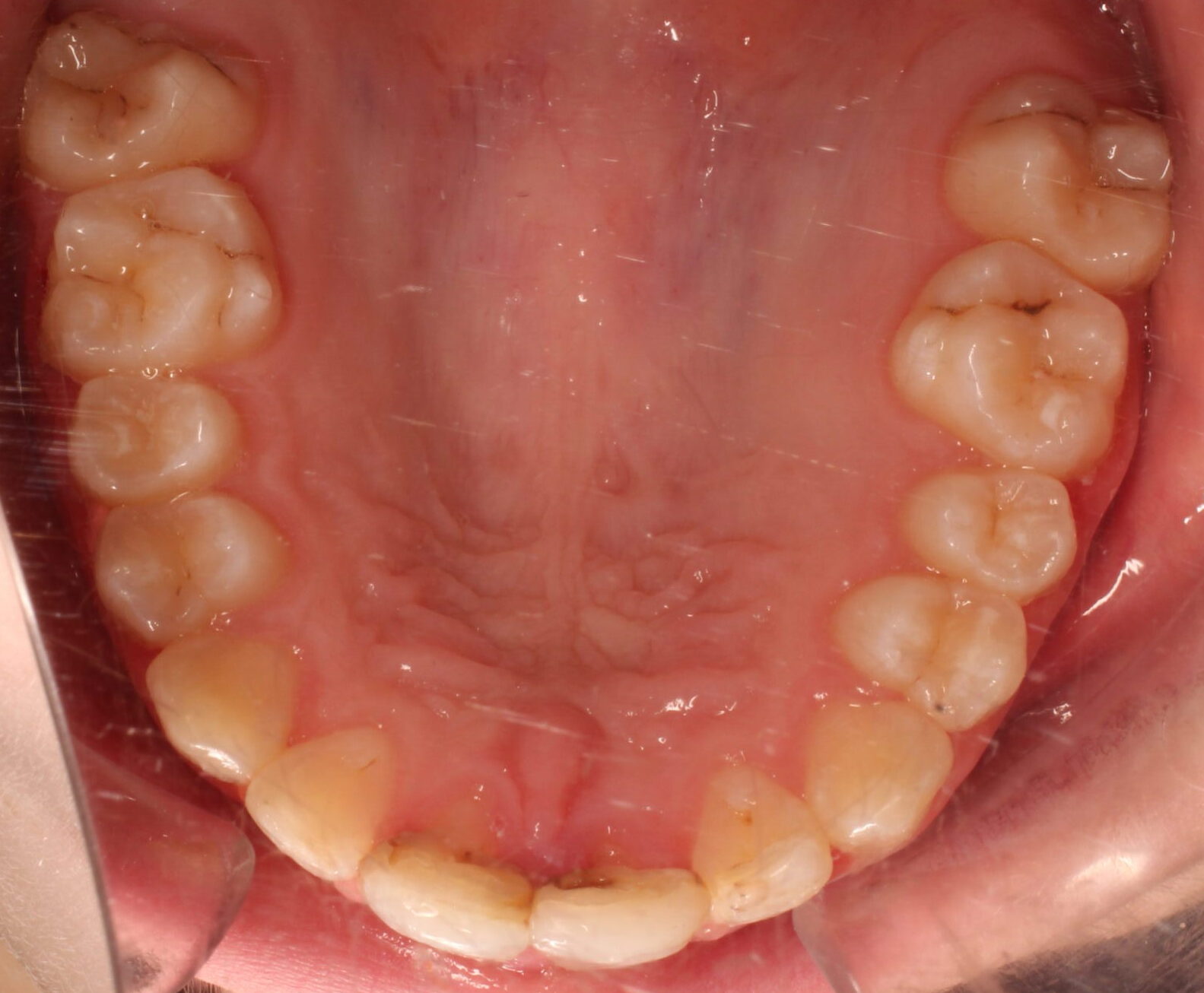 After braces upper teeth