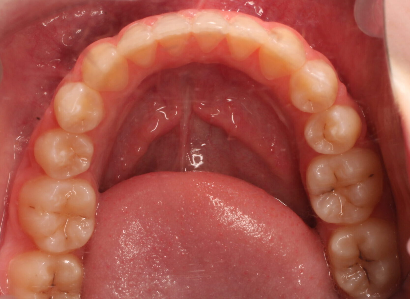 After braces lower teeth