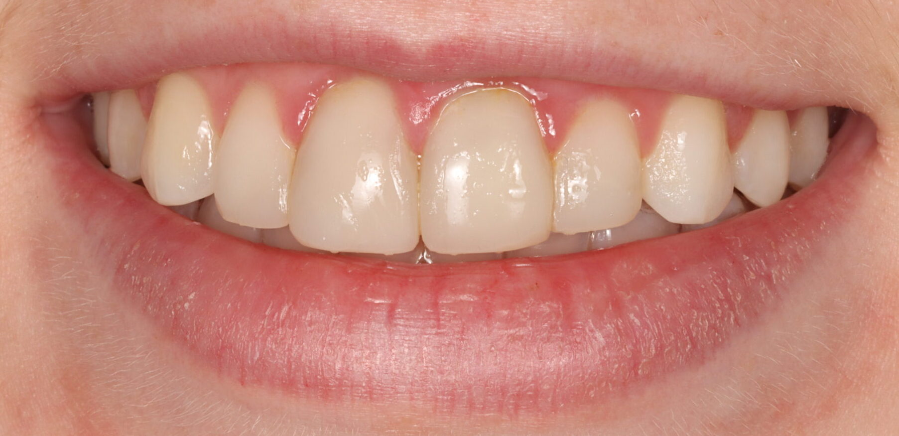 After braces front teeth