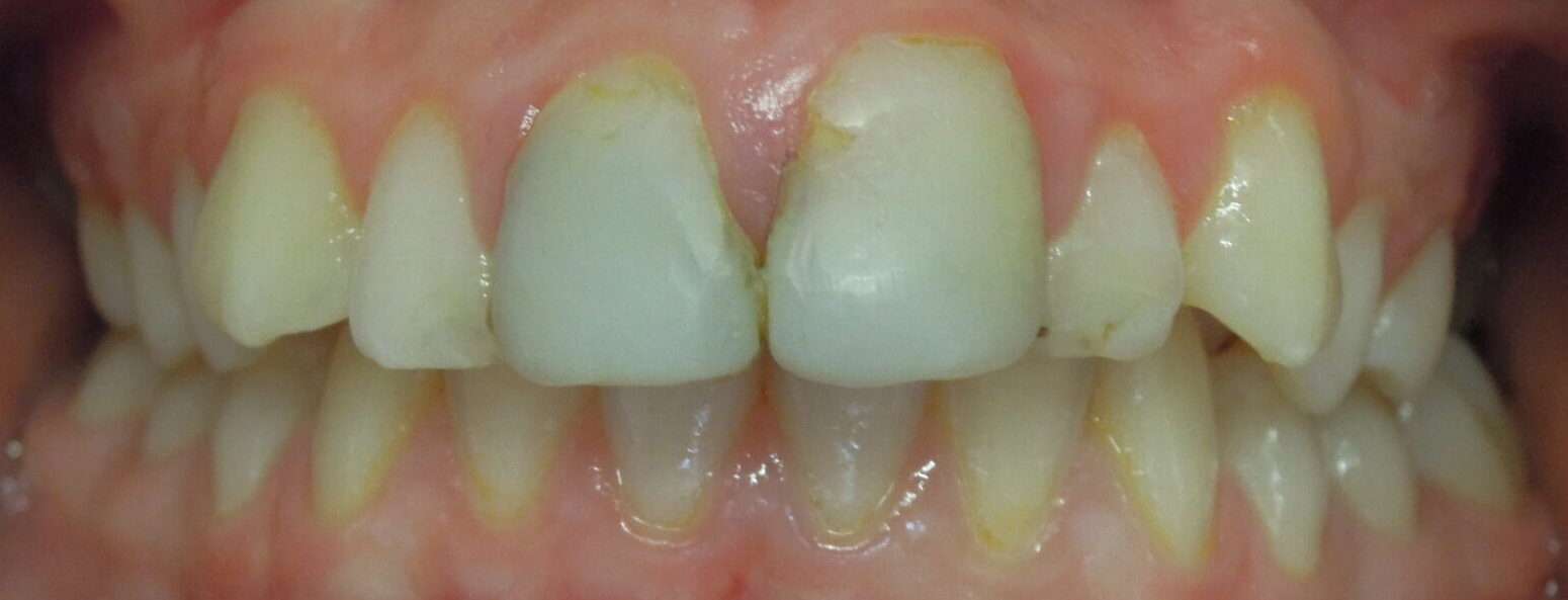 Before braces front teeth