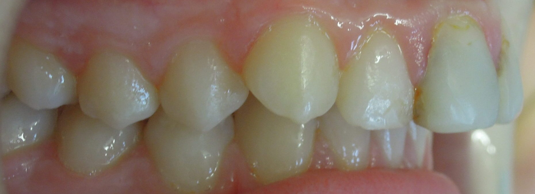 Before braces right teeth