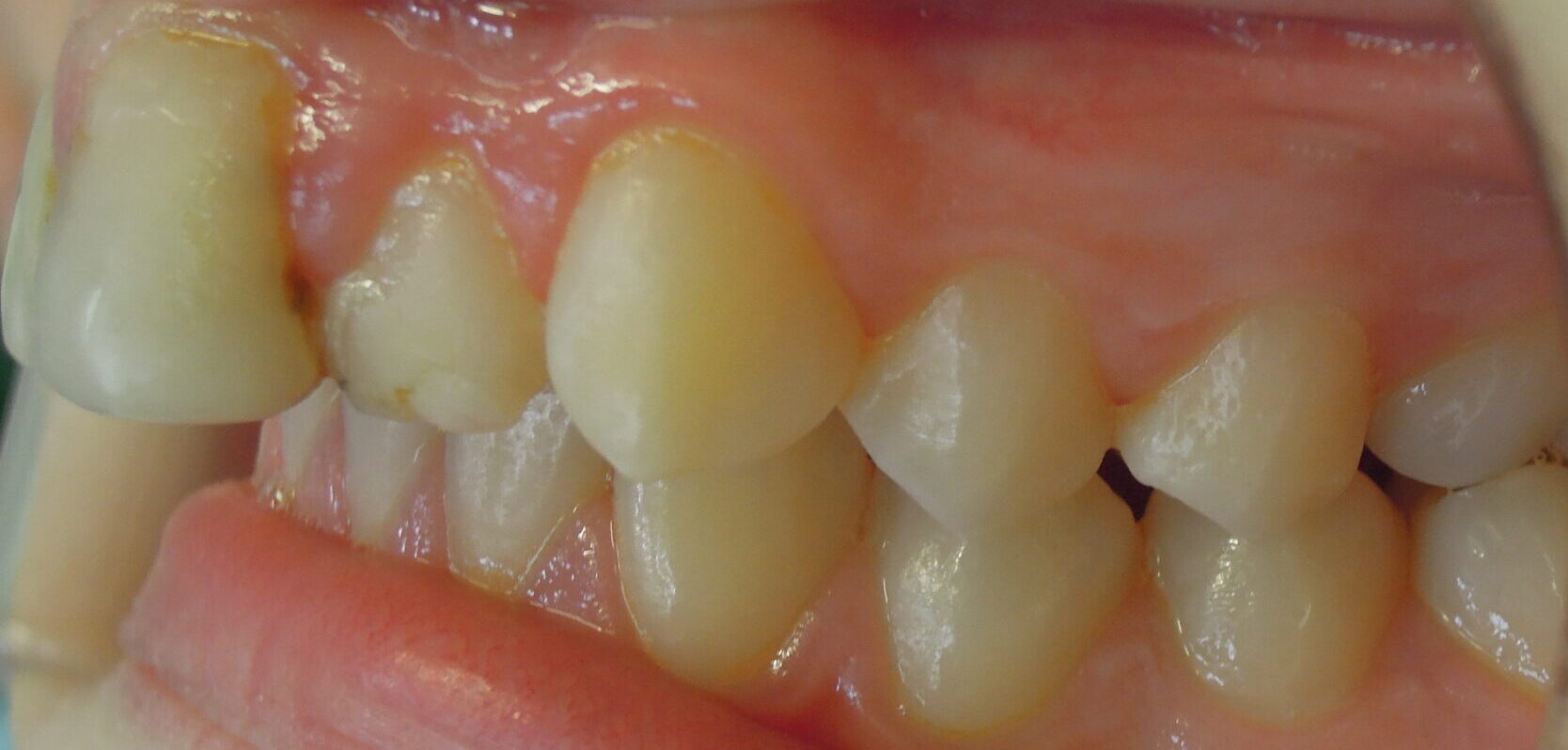 Before braces left teeth
