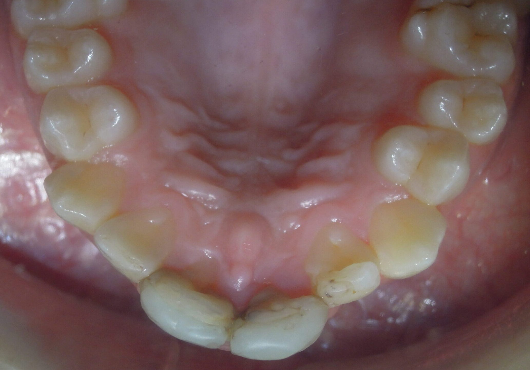 Before braces upper teeth