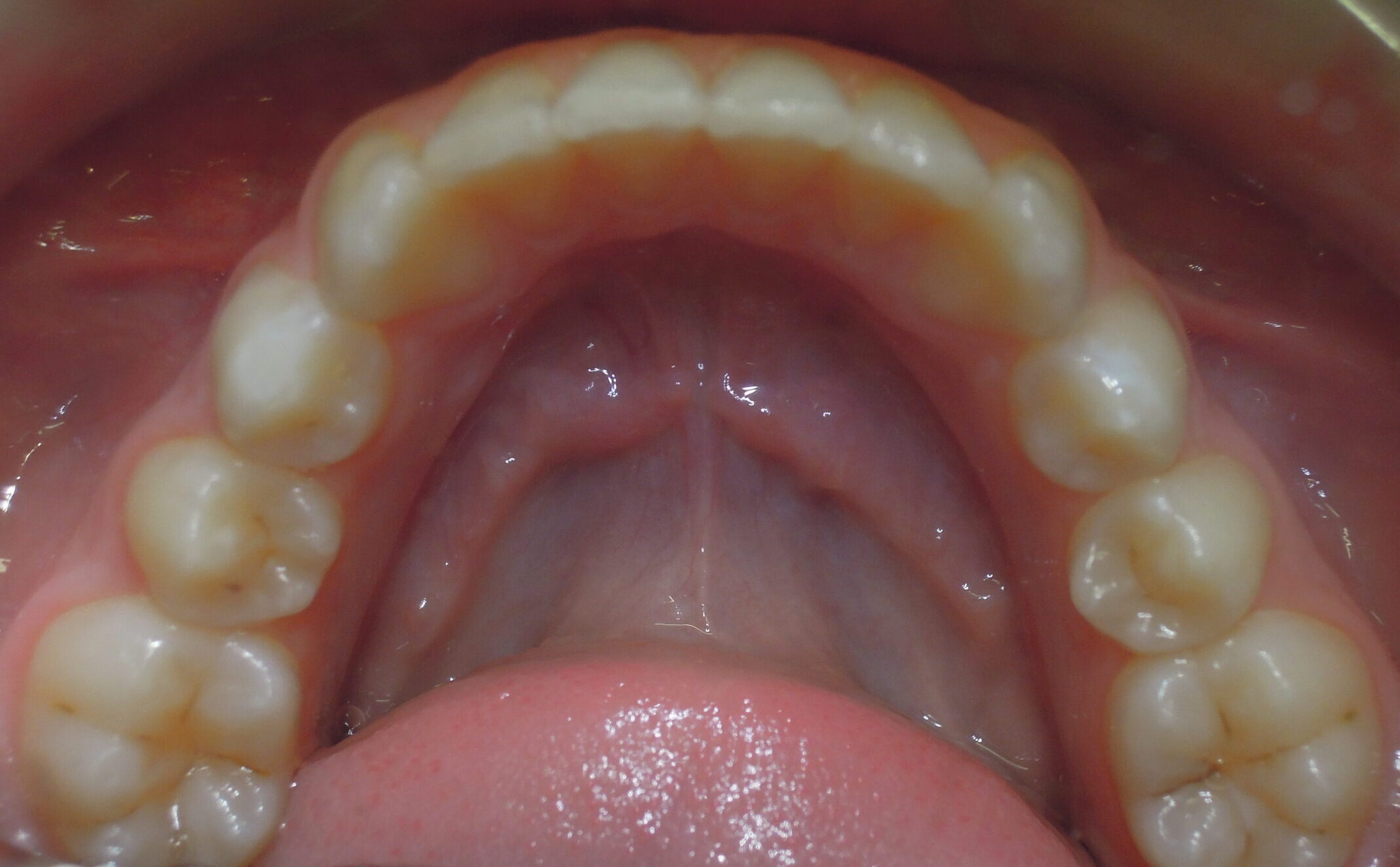 Before braces lower teeth