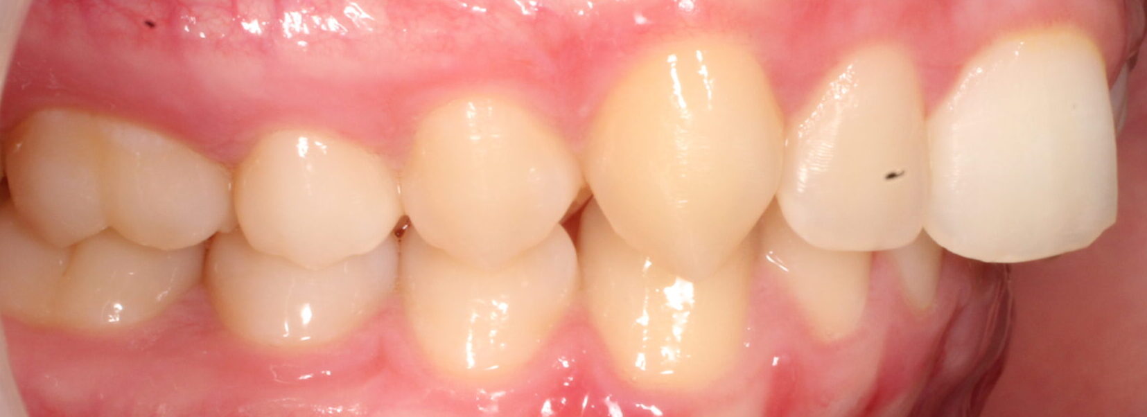 Before braces right teeth