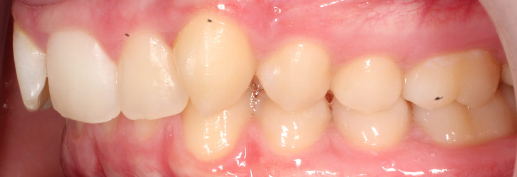 Before braces left teeth