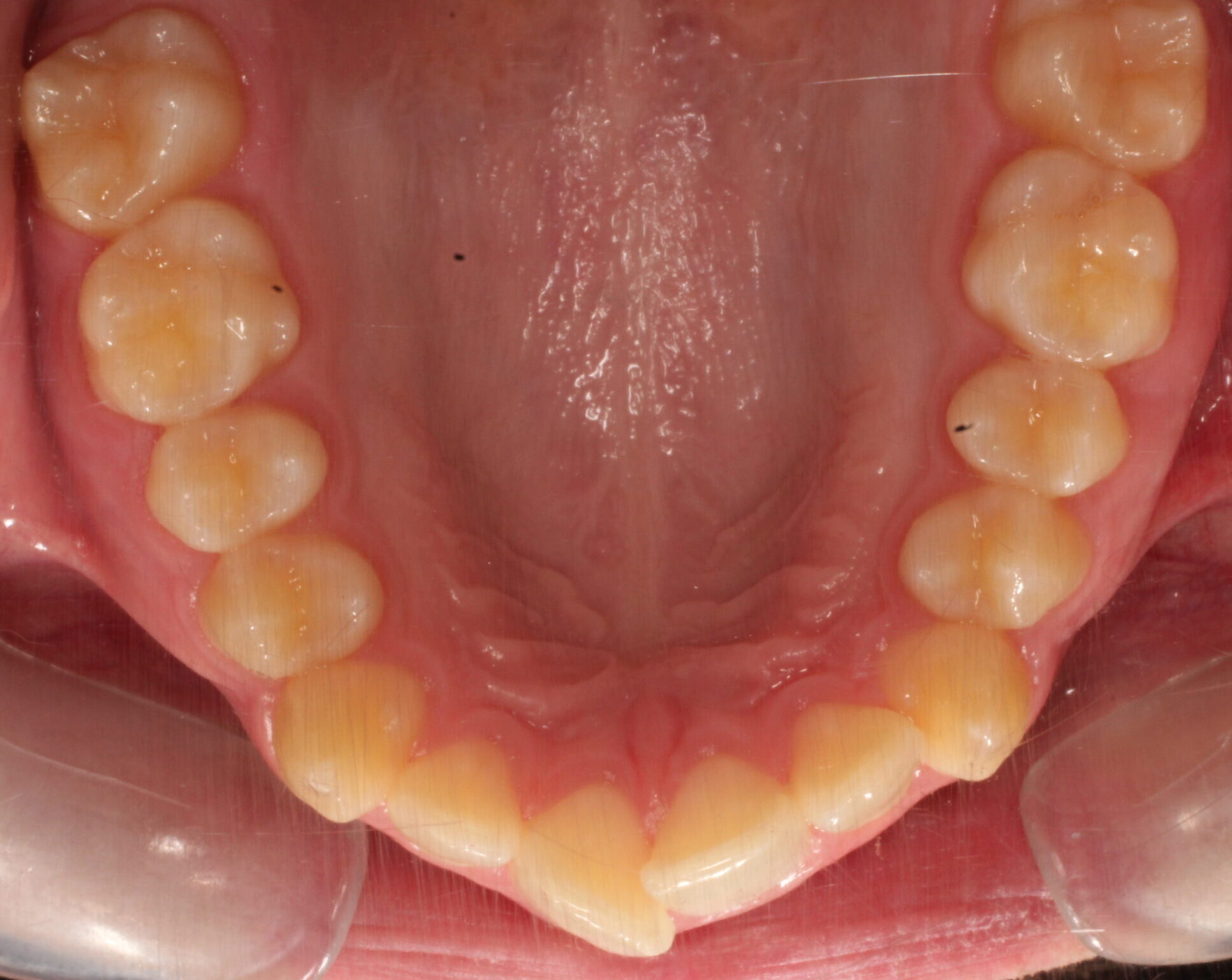 Before braces upper teeth