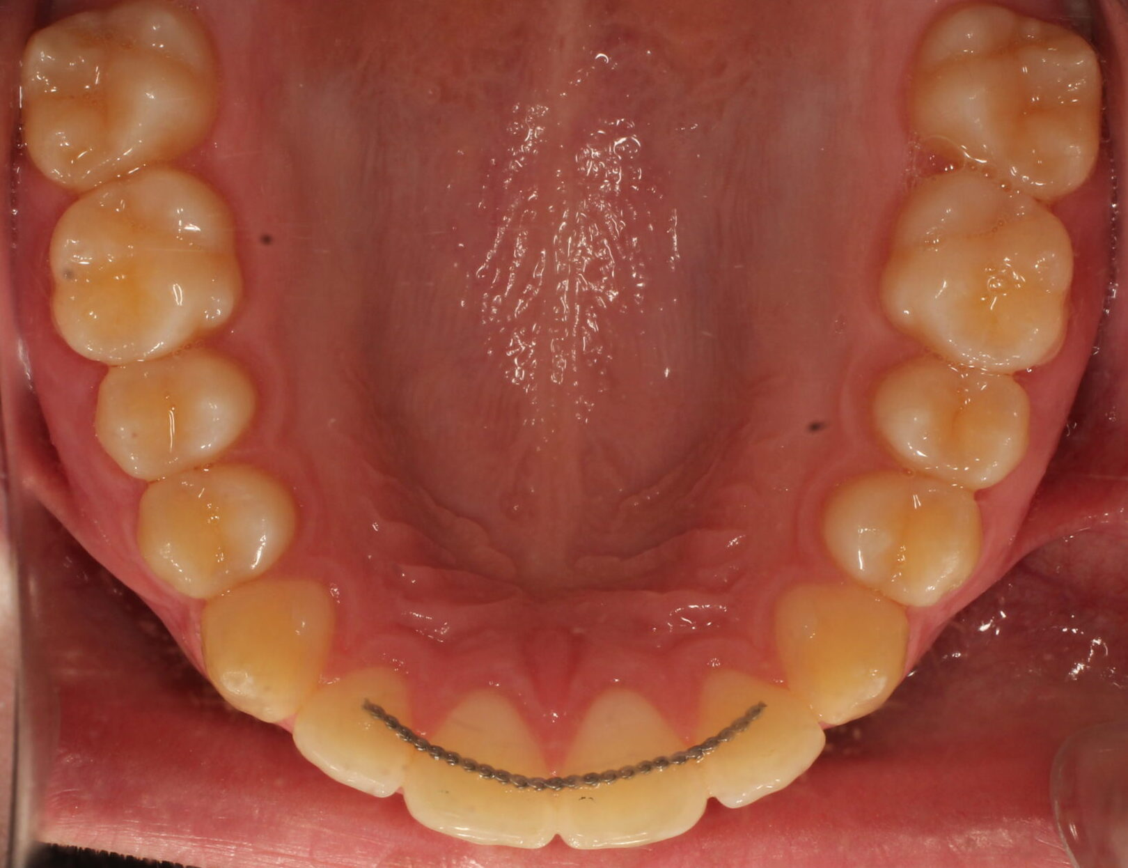After braces upper teeth